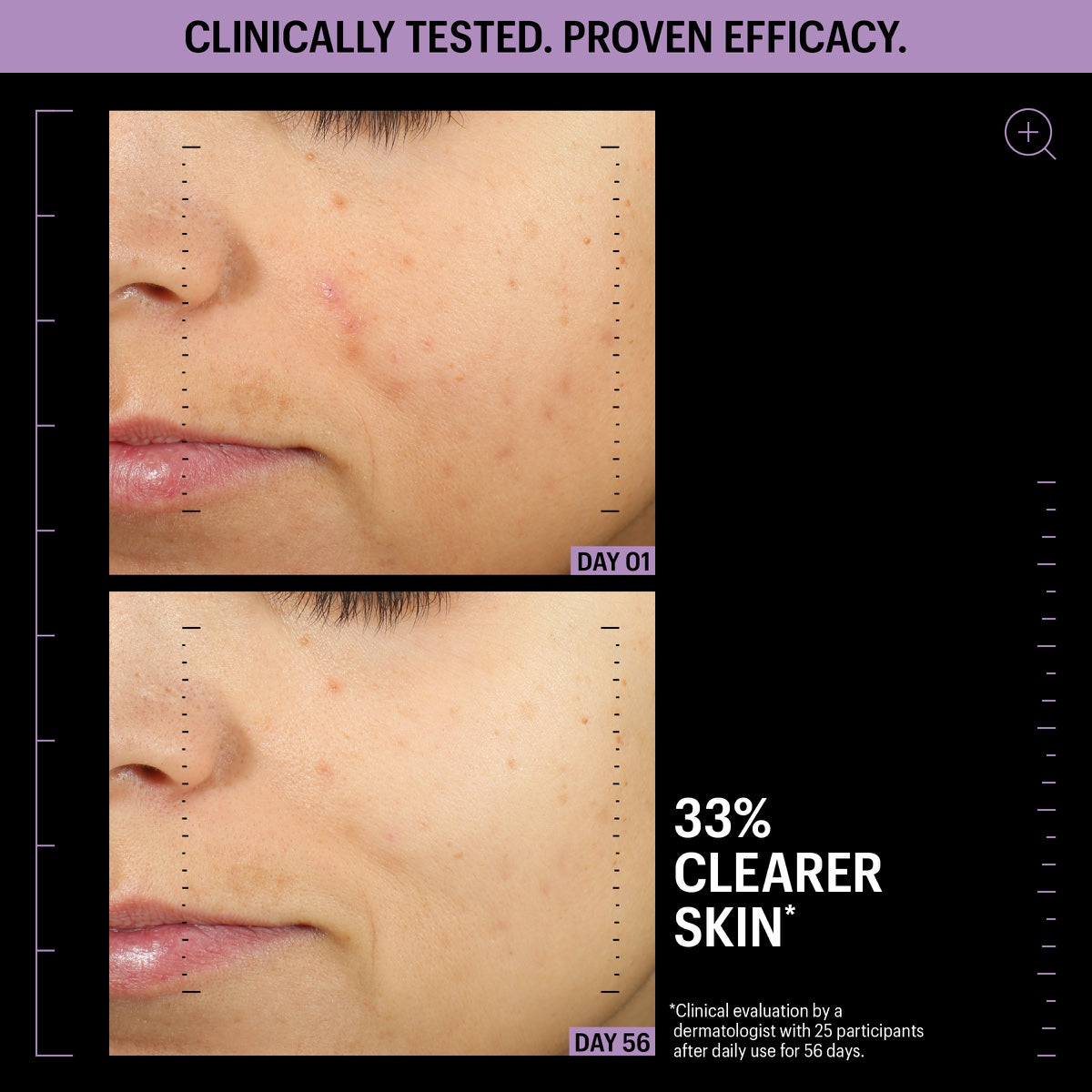 Allies of Skin azelaic serum review before and after cheek close up showing clearer skin Day 1 and Day 56 33 percent clearer