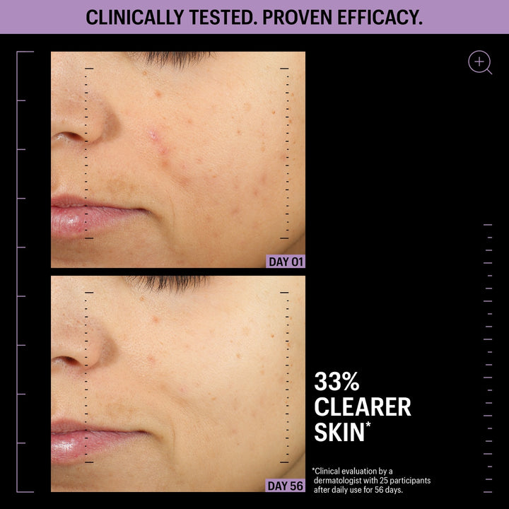 Allies of Skin azelaic serum review before and after cheek close up showing clearer skin Day 1 and Day 56 33 percent clearer