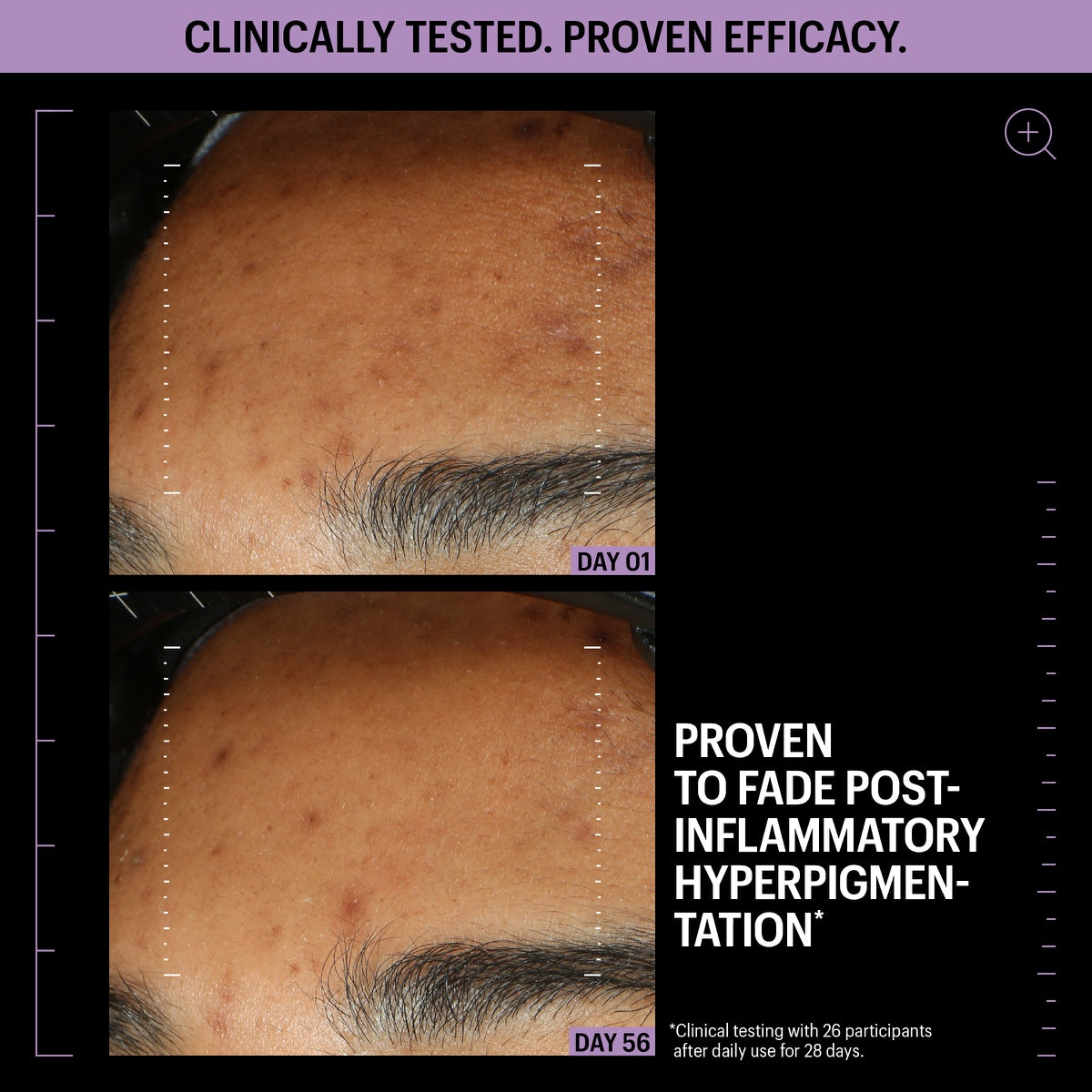 Before and after forehead close up showing reduced hyperpigmentation Day 01 to Day 56 Allies of Skin azelaic serum review