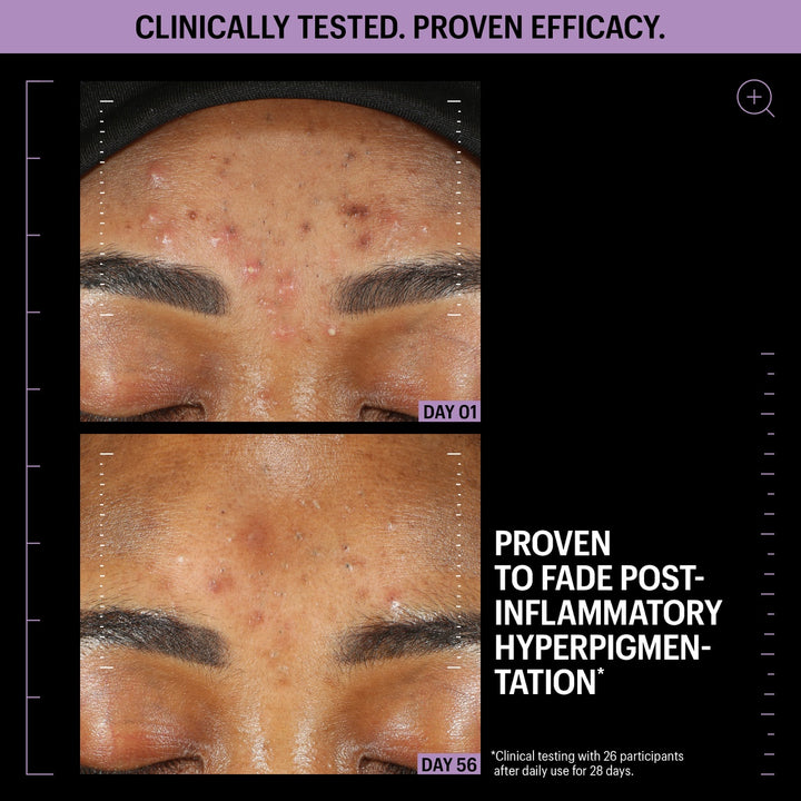 Before and after forehead closeup showing reduced acne and hyperpigmentation Day 01 to Day 56 Allies of Skin azelaic serum review