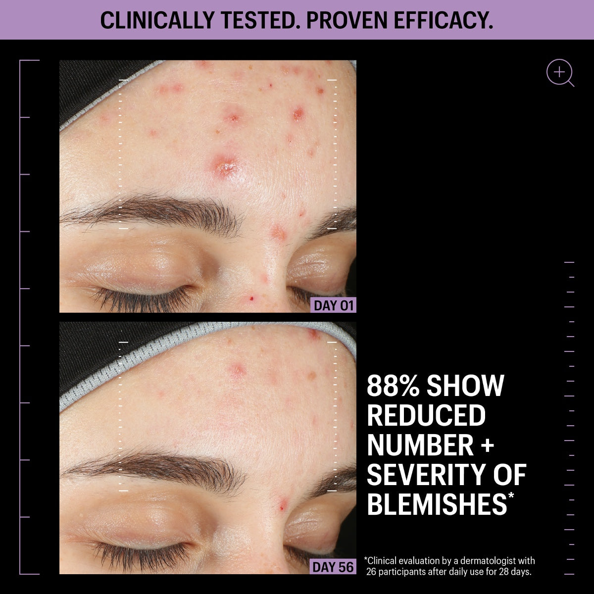 Allies of Skin azelaic serum review before and after forehead acne photos showing reduced blemishes day 01 to day 56