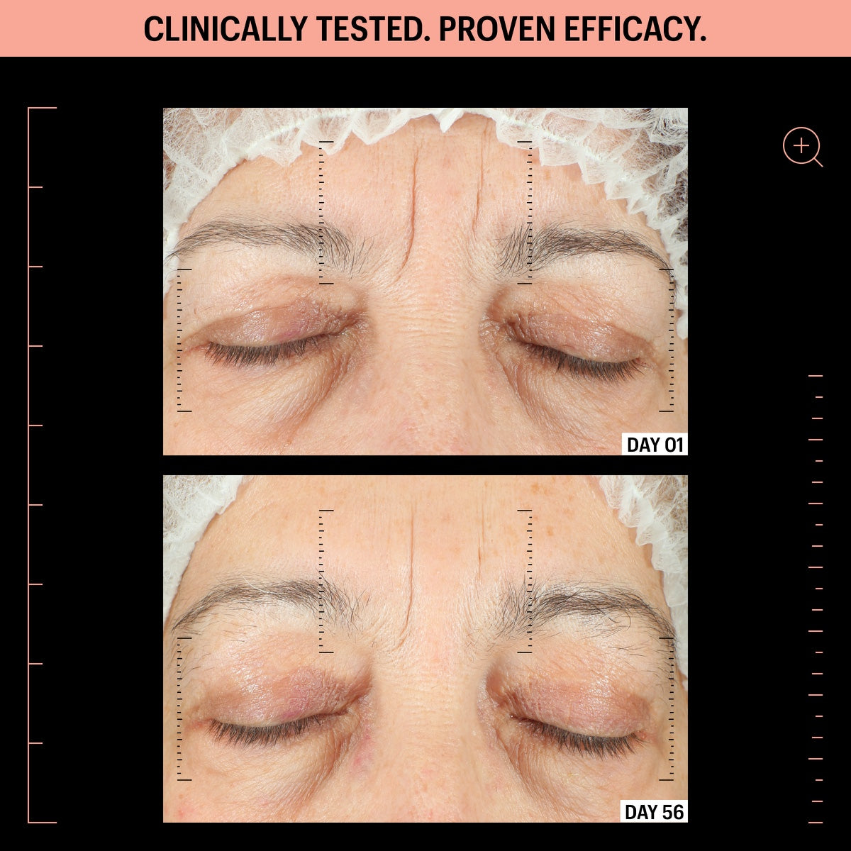 Before and after showing reduced forehead and eyelid wrinkles day 01 to 56 using peptide firming moisturizer