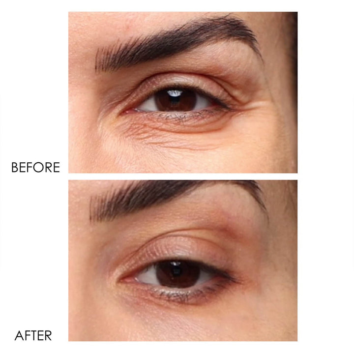 Dermelect Revitalite for dark circles before and after close up showing reduced under eye darkness and wrinkles