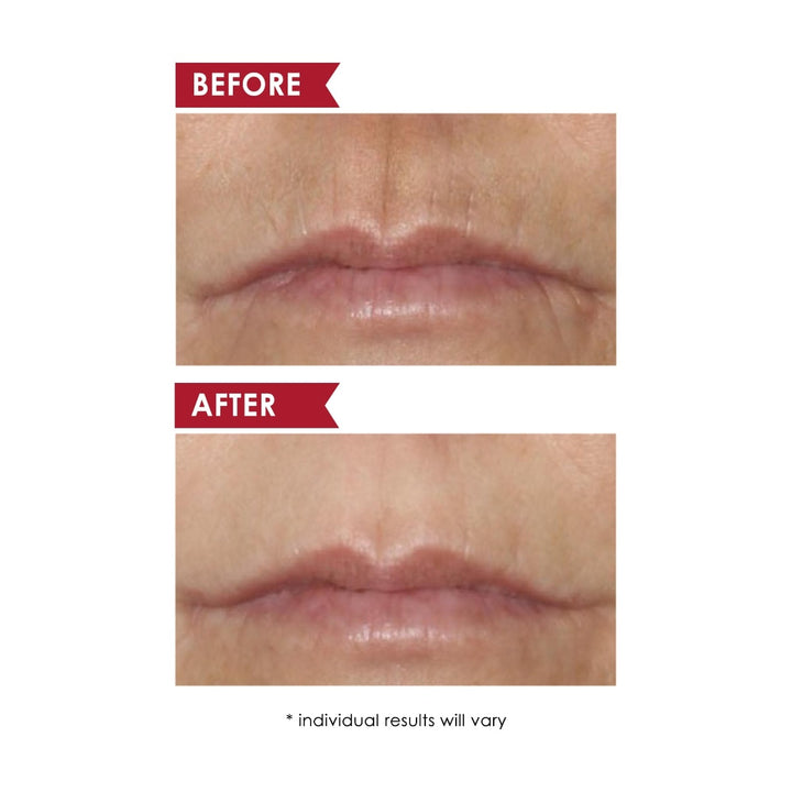 Dermelect before and after close up of upper lip showing reduced vertical lines after using upper lip anti-aging cream