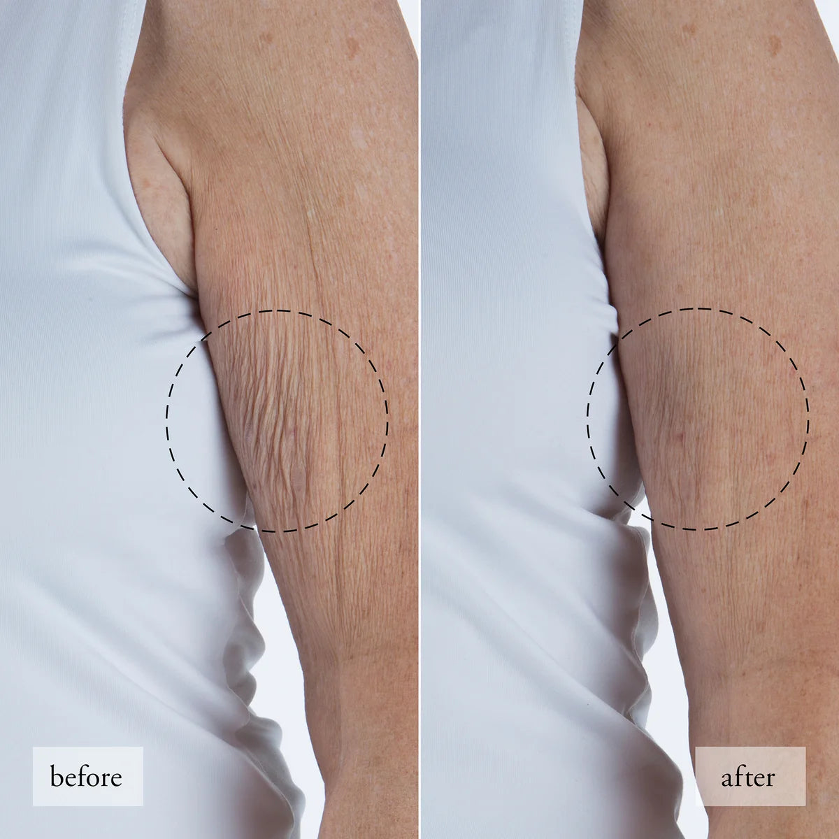 Before and after comparison of arm skin showing improvement using Philosophy resurfacing body serum